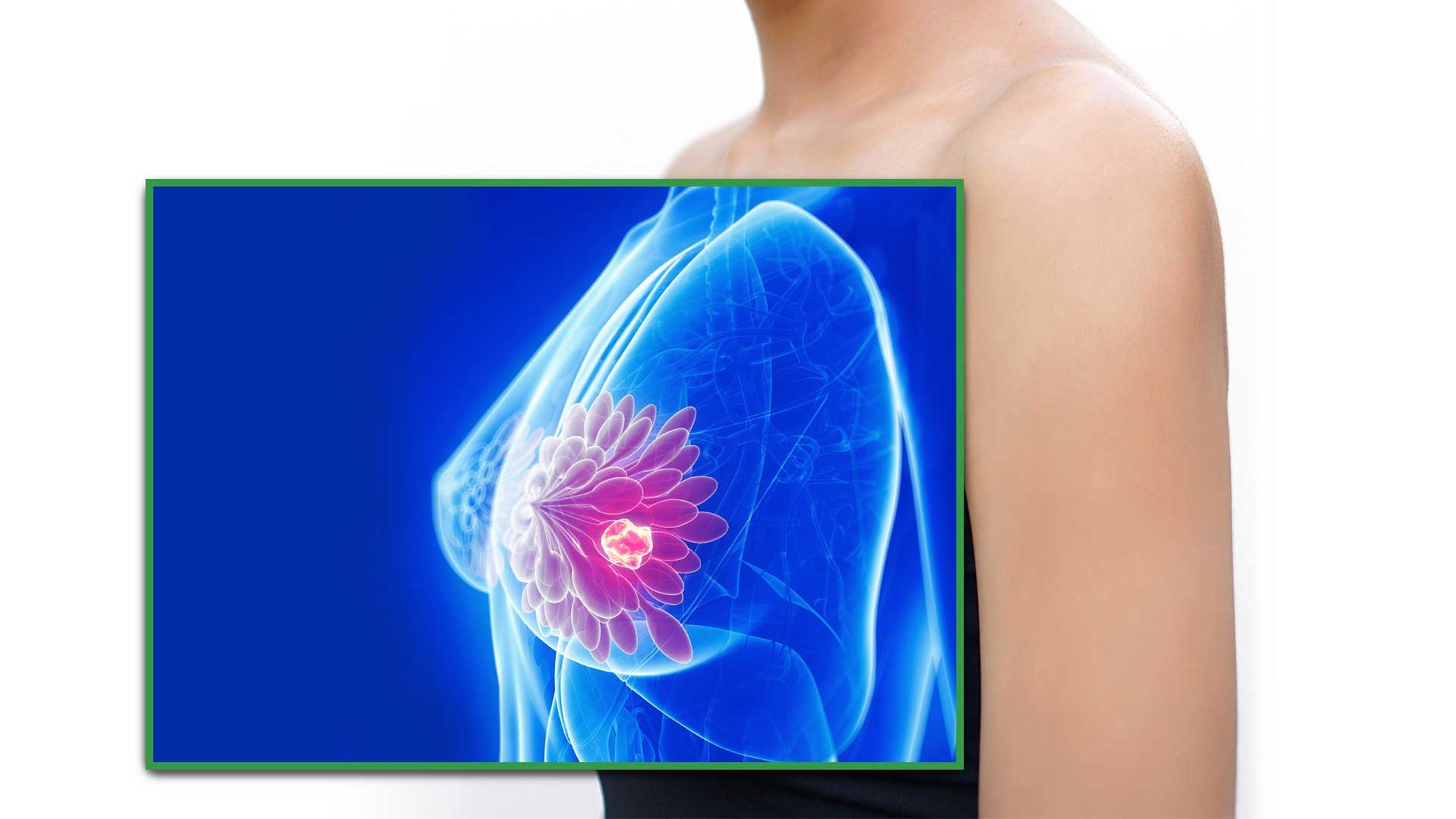 Case Study: Stage 4 Breast Cancer ER+/ PR+/HER2 (3+) (Triple Positive), Invasive Ductal Carcinoma with Metastasis to Liver, Bones, and Abdomen