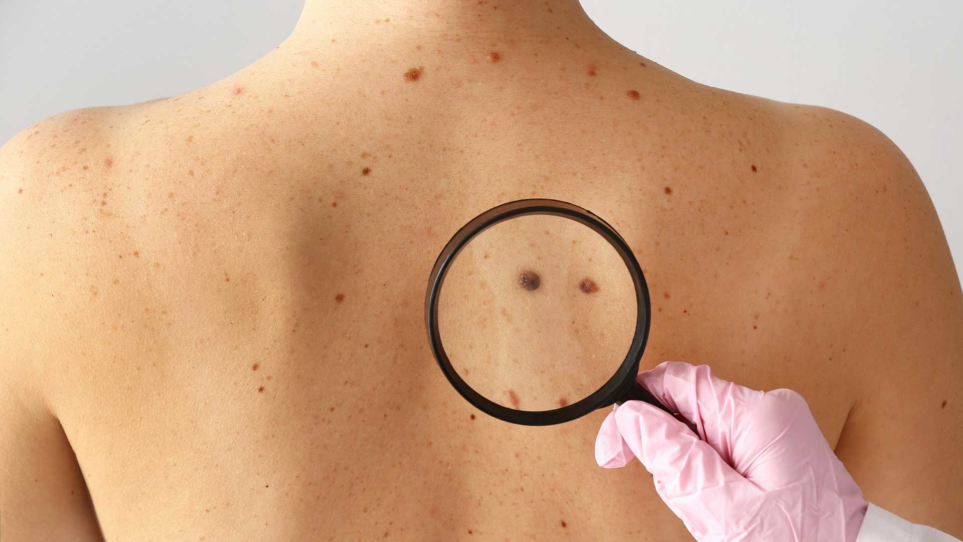 Dr. Dino Prato of Envita Medical Centers Shares His Opinion with Business Times on Skin Cancer Myths
