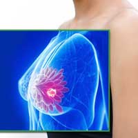 Case Study: Stage 4 Breast Cancer ER+/ PR+/HER2 (3+) (Triple Positive), Invasive Ductal Carcinoma with Metastasis to Liver, Bones, and Abdomen